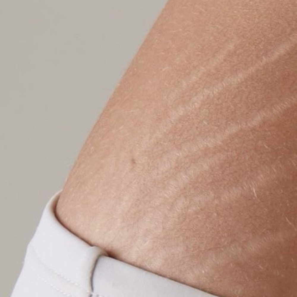 Inkless Stretch Mark Revision